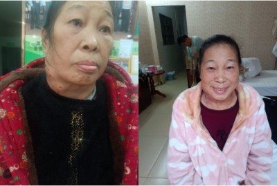 痔疮鼻炎无效退款，广西百色杨忠雅医师