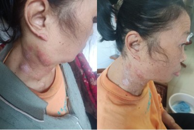 痔疮鼻炎无效退款，广西百色杨忠雅医师