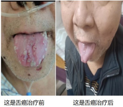 尿毒症乳腺癌不讲价钱凭良心给广西百色杨忠雅