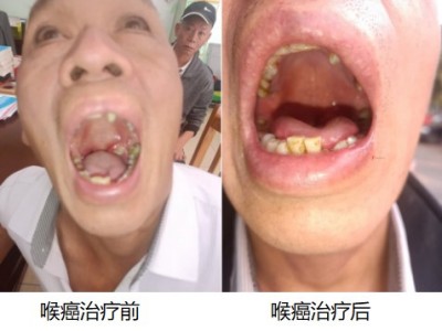 尿毒症乳腺癌不讲价钱凭良心给广西百色杨忠雅