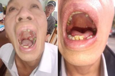 目前乳腺癌来一个治好一个 ——广西百色杨忠雅