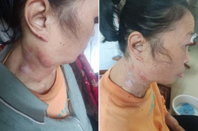 目前乳腺癌来一个治好一个 ——广西百色杨忠雅