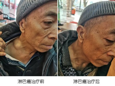 广西百色市杨忠雅治疗各种癌症有成就