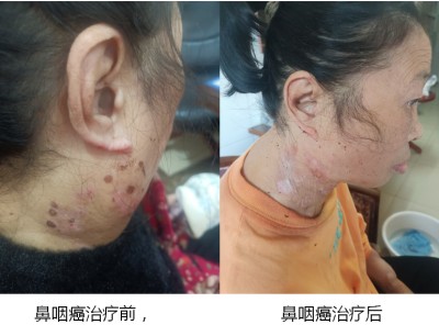 广西百色市杨忠雅治疗各种癌症有成就