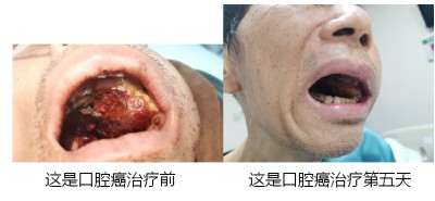 广西百色市杨忠雅治疗各种癌症有成就