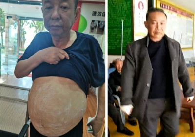 广西百色市杨忠雅治疗各种癌症有成就