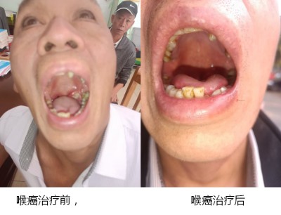 广西百色市杨忠雅治疗各种癌症有成就