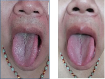 广西中医特色疗法传承导师——梁爱瑟