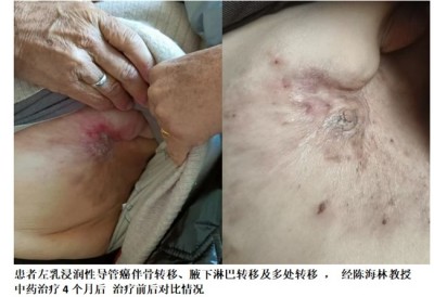 陈海林教授三焦气化法 ：开创乳腺癌治疗新路径